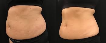 EvolveX Tighten, Tone and Sculpt - EvolveX is the ultimate hands-free platform for a body transformation. Patients continue to seek non-invasive treatments at unprecedented levels, pursuing non-invasive alternatives for body treatments. This all-in-one platform delivers multiple technologies on one system. Treat one area or multiple areas at once. EvolveX Tighten, Tone and Sculpt - EvolveX is the ultimate hands-free platform for a body transformation. Patients continue to seek non-invasive treatments at unprecedented levels, pursuing non-invasive alternatives for body treatments. This all-in-one platform delivers multiple technologies on one system. Treat one area or multiple areas at once.