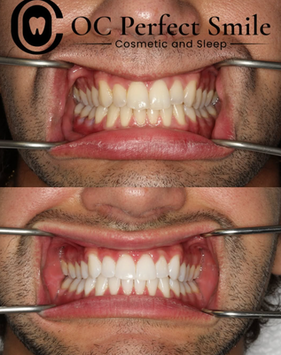 Invisalign - Invisalign in Orange County performed by Dr. Haghighi of OC Perfect Smile. Call (949) 810-0121