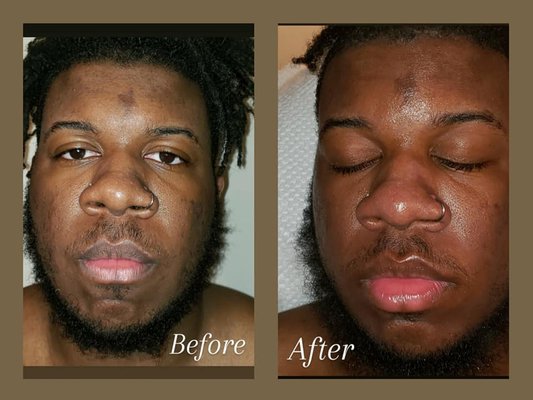 Gentlemen's Facial w/Beard Treatment - Acne treatment for acne-prone skin. GlyMed Plus OXYGEN Deep Pore Cleanser contains an oxygen packed infusion that percolates within the pores triggering a deep desincrustation process to thoroughly cleanse, purify and decongest pores, stimulating healthy cell turnover and revealing a younger, smoother looking complexions. This product is recommended for all skin types, especially those with oily, acneic, blackheads, and large pores associated with aging. Gentlemen's Facial w/Beard Treatment - Acne treatment for acne-prone skin. GlyMed Plus OXYGEN Deep Pore Cleanser contains an oxygen packed infusion that percolates within the pores triggering a deep desincrustation process to thoroughly cleanse, purify and decongest pores, stimulating healthy cell turnover and revealing a younger, smoother looking complexions. This product is recommended for all skin types, especially those with oily, acneic, blackheads, and large pores associated with aging.