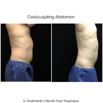 Coolsculpting plus Emsculpt combination - Coolsculpting is Nonsurgical and is effective in removing fat for good. Come to visit Dr Sheena Kong and see if you are a good candidate. Also, seasonal special is still available. Check our website www.sheenakong.com and look under specials. Coolsculpting plus Emsculpt combination - Coolsculpting is Nonsurgical and is effective in removing fat for good. Come to visit Dr Sheena Kong and see if you are a good candidate. Also, seasonal special is still available. Check our website www.sheenakong.com and look under specials.