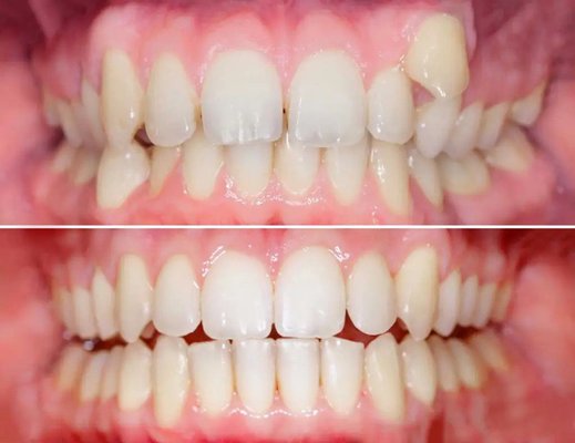 Invisalign Overbite Correction - Check out this amazing transformation! ✨ Invisalign corrected this patient's bite and guided an ectopic canine into place for a healthier, more aligned smile. Clear aligners, big results! 😁 Ready to transform your smile? Book a consultation today! #Invisalign #SmileTransformation Invisalign Overbite Correction - Check out this amazing transformation! ✨ Invisalign corrected this patient's bite and guided an ectopic canine into place for a healthier, more aligned smile. Clear aligners, big results! 😁 Ready to transform your smile? Book a consultation today! #Invisalign #SmileTransformation