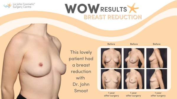 Breast Reduction - If your large breasts are making daily activities difficult and affecting your comfort, a breast reduction can help. It can give you a smaller, more attractive shape and boost your self-confidence. Here are before and after photos of breast reduction results by the board-certified plastic surgeons at La Jolla Cosmetic Surgery Centre in La Jolla, CA. Breast Reduction - If your large breasts are making daily activities difficult and affecting your comfort, a breast reduction can help. It can give you a smaller, more attractive shape and boost your self-confidence. Here are before and after photos of breast reduction results by the board-certified plastic surgeons at La Jolla Cosmetic Surgery Centre in La Jolla, CA.