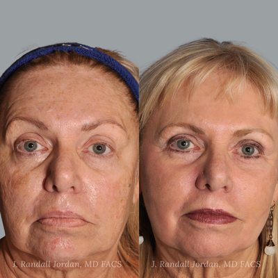 Non Surgical Facial Rejuvenation - Faces, PLLC offers a number of non-surgical facial rejuvenation options to help you achieve your asesthetici goals. Some of these options include:

Neurotoxins, such as Botox®, Daxxify® and Dysport®
Dermal Fillers, including the following lines: Juvéderm®, Sculptra®, Radiesse®, The Restylane® and RHA®
Intense Pulsed Light or IPL Photofacial
Fractional CO2 Laser
Deep Chemical Peels as performed by Dr. Jordan
Skin Tightening with the PiXel8-RF
