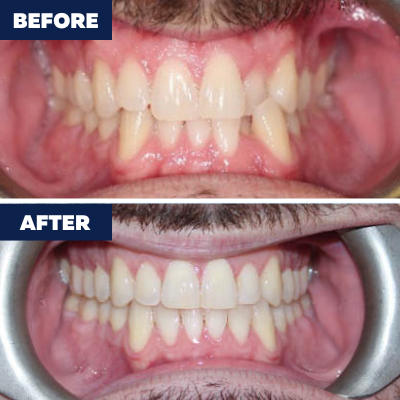 Orthodontics Before/After Transformations! - El Segundo Modern Dentistry and Orthodontics offers a variety of orthodontic treatments to El Segundo and surrounding areas. We offer Invisalign clear aligners, metal braces, porcelain braces and retainers. Call us to schedule a consultation! (424) 277-2669 https://www.dentistelsegundo.com/