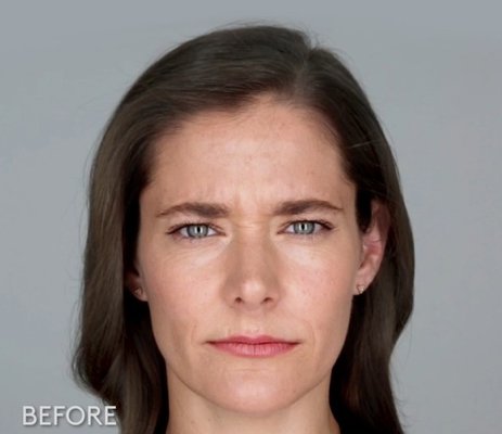 Botox - Before and after Botox Treatments