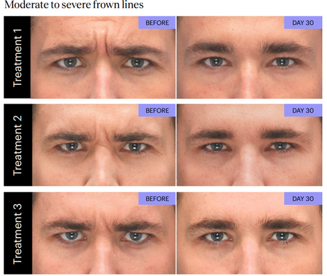 BOTOX® Cosmetic Upper Facial Line - Before and After - Botox® Cosmetic Results: Smoother, Youthful, and Refreshed Appearance
At Pure Medical Spa, we deliver natural-looking Botox® results that reduce fine lines and wrinkles while maintaining facial expression and balance. These real patient photos show visible improvements in moderate to severe frown lines, crow’s feet, and forehead lines after treatment.
Within just 30 days, patients experienced a noticeable softening of deep wrinkles, achieving smoother and more relaxed features. Each treatment was designed to target specific expression lines, helping restore youthful definition without overcorrection.
✨ Visible improvements include:
Softer frown lines between the brows
Reduced crow’s feet around the eyes
Minimized forehead lines and smoother skin texture
At Pure Medical Spa, every Botox® treatment is customized to your unique facial anatomy, ensuring subtle, rejuvenated results that enhance your natural beauty.
Individual results may vary. Photos taken before treatment, after 2 days, 30 days, and 4 months. BOTOX® Cosmetic Upper Facial Line - Before and After - Botox® Cosmetic Results: Smoother, Youthful, and Refreshed Appearance
At Pure Medical Spa, we deliver natural-looking Botox® results that reduce fine lines and wrinkles while maintaining facial expression and balance. These real patient photos show visible improvements in moderate to severe frown lines, crow’s feet, and forehead lines after treatment.
Within just 30 days, patients experienced a noticeable softening of deep wrinkles, achieving smoother and more relaxed features. Each treatment was designed to target specific expression lines, helping restore youthful definition without overcorrection.
✨ Visible improvements include:
Softer frown lines between the brows
Reduced crow’s feet around the eyes
Minimized forehead lines and smoother skin texture
At Pure Medical Spa, every Botox® treatment is customized to your unique facial anatomy, ensuring subtle, rejuvenated results that enhance your natural beauty.
Individual results may vary. Photos taken before treatment, after 2 days, 30 days, and 4 months.