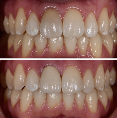 Veneers - Veneer cases