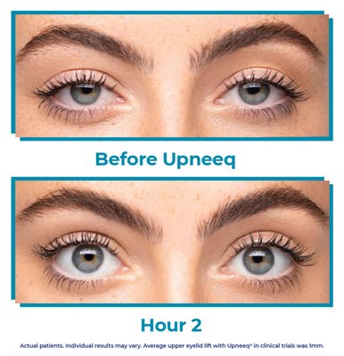 UPNEEQ, Revolutionary Eyelid Lifting Drops - UPNEEQ was developed to help acquired ptosis, which is low lying lids. Acquired ptosis can lead to vision impairment. Low-lying eyelid(s) can affect eyesight by not only blocking your vision, but also by reducing field of vision, which may interfere with day-to-day functions such as:
-Reading
-Driving
-Computer use
Looking up without the need to tilt your head back
Just one drop in each eye will whiten and open the eye, ALL day! We are proud to offer UPNEEQ to our clients at Revive, call & ask about it today! Mention Yelp for 10% off your box of 45! UPNEEQ, Revolutionary Eyelid Lifting Drops - UPNEEQ was developed to help acquired ptosis, which is low lying lids. Acquired ptosis can lead to vision impairment. Low-lying eyelid(s) can affect eyesight by not only blocking your vision, but also by reducing field of vision, which may interfere with day-to-day functions such as:
-Reading
-Driving
-Computer use
Looking up without the need to tilt your head back
Just one drop in each eye will whiten and open the eye, ALL day! We are proud to offer UPNEEQ to our clients at Revive, call & ask about it today! Mention Yelp for 10% off your box of 45!
