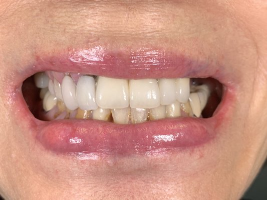 Combination Treatment for Extremely Challeniging Case: Gum Disease, Old Implants, Failing Teeth, Missing Teeth, Bad Bite - This was an extremely challenging case. She was seeing a world famous dentist in California who teaches around the world on implants. After a couple of years of special orthodontic treatment, dental implant work, bone grafting she got fed up and lost confidence with the dentist. Although a complex case, I try to look at what the client actually wants and figure out ways to deliver results. To rebuild the foundation I did laser gum surgery (LANAP), then removed decay that set into many of her teeth. I used the implants she already had and built around them. And although she was initially against anything removable, she decided to give it a try while deciding on whether or not to do sinus surgery which we could have done. After trying the removable (to replace back side molars on top), she really liked the smile from all the rework and bite correction, she got used to the removable and decided not to do the sinus surgery and additional implants. I'm not here to sell more dentistry but rather give options that I feel that would work for each individual client. Combination Treatment for Extremely Challeniging Case: Gum Disease, Old Implants, Failing Teeth, Missing Teeth, Bad Bite - This was an extremely challenging case. She was seeing a world famous dentist in California who teaches around the world on implants. After a couple of years of special orthodontic treatment, dental implant work, bone grafting she got fed up and lost confidence with the dentist. Although a complex case, I try to look at what the client actually wants and figure out ways to deliver results. To rebuild the foundation I did laser gum surgery (LANAP), then removed decay that set into many of her teeth. I used the implants she already had and built around them. And although she was initially against anything removable, she decided to give it a try while deciding on whether or not to do sinus surgery which we could have done. After trying the removable (to replace back side molars on top), she really liked the smile from all the rework and bite correction, she got used to the removable and decided not to do the sinus surgery and additional implants. I'm not here to sell more dentistry but rather give options that I feel that would work for each individual client.