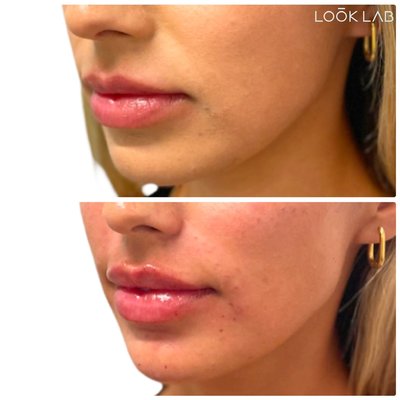 Fillers - Before/After Fillers - Before/After