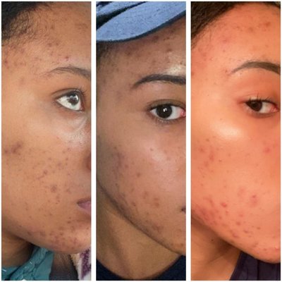 Microneedling - These results are after one Microneedling treatment. Microneedling - These results are after one Microneedling treatment.