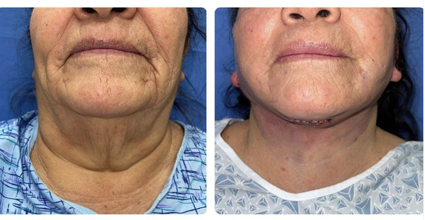 Face & Neck Lift - Noticing some extra skin sagging around the mouth, cheeks and neck? Ready for a refreshed version of yourself? With over 25 years experience, Dr. Barnes can evaluate your face & neck in a consultation by phone or in person. Call us to make an appointment! Face & Neck Lift - Noticing some extra skin sagging around the mouth, cheeks and neck? Ready for a refreshed version of yourself? With over 25 years experience, Dr. Barnes can evaluate your face & neck in a consultation by phone or in person. Call us to make an appointment!