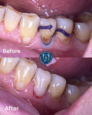 Restoring buccal abrasions - Say goodbye to tooth sensitivity! Restoring buccal abrasions brings back comfort and helps protect your smile.
This patient came to us struggling with tooth sensitivity caused by buccal abrasions, those notches or worn areas near the gumline that expose sensitive tooth roots.
With expert care from Dr. Sepi at Sigma Dental Clinic, we restored the affected areas using gentle, precise techniques. The result? Improved comfort, protection, and a healthier-looking smile.
Restoring buccal abrasions not only relieves sensitivity but also helps prevent future damage and decay.
📍 Chicago-based care that puts your comfort first.
Call: +1 773-506-2033
Visit: sigmadentalclinic.com Restoring buccal abrasions - Say goodbye to tooth sensitivity! Restoring buccal abrasions brings back comfort and helps protect your smile.
This patient came to us struggling with tooth sensitivity caused by buccal abrasions, those notches or worn areas near the gumline that expose sensitive tooth roots.
With expert care from Dr. Sepi at Sigma Dental Clinic, we restored the affected areas using gentle, precise techniques. The result? Improved comfort, protection, and a healthier-looking smile.
Restoring buccal abrasions not only relieves sensitivity but also helps prevent future damage and decay.
📍 Chicago-based care that puts your comfort first.
Call: +1 773-506-2033
Visit: sigmadentalclinic.com