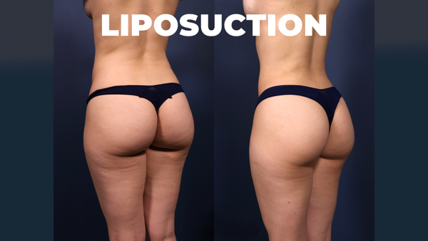 Liposuction - As a body contouring specialist, one of the procedures I am best known for is liposuction. While there are many plastic surgeons in the Los Angeles area and Santa Monica, liposuction requires advanced medical and surgical knowledge to perform safely. Artistic vision and skilled hands are necessary to sculpt beautifully. My experience combining the art and science of liposuction for thousands of cases allows me to consistently achieve beautiful results for my patients.