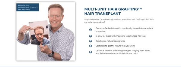 MULTI-UNIT HAIR GRAFTING™ HAIR TRANSPLANT - Why choose We Grow Hair Indy and our Multi-Unit Hair Grafting™ FUT hair transplant procedure?
Get up to 3x the hair and 2x the density in one hair transplant procedure
Is ideal for those with moderate to advanced hair loss
Results in a natural appearance
Costs less to get the results that you want
Utilizes a blend of different graft types ranging from micro and follicular units to multiple follicular units MULTI-UNIT HAIR GRAFTING™ HAIR TRANSPLANT - Why choose We Grow Hair Indy and our Multi-Unit Hair Grafting™ FUT hair transplant procedure?
Get up to 3x the hair and 2x the density in one hair transplant procedure
Is ideal for those with moderate to advanced hair loss
Results in a natural appearance
Costs less to get the results that you want
Utilizes a blend of different graft types ranging from micro and follicular units to multiple follicular units