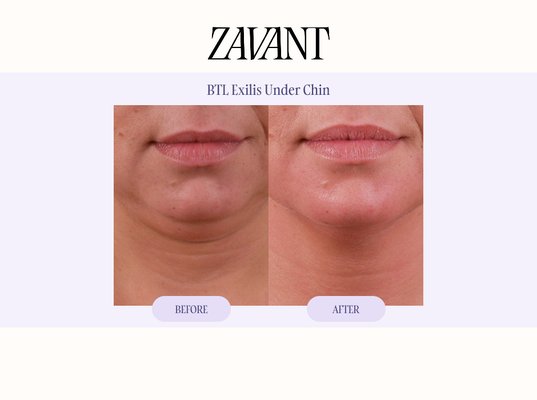 BTL Exilis - Explore BTL Exilis before & after results at Zavant Aesthetics. This non-surgical treatment uses radiofrequency and ultrasound energy to support fat reduction, skin tightening, collagen remodeling, and smoother body contouring.
BTL Exilis can be used on select areas of the face and body to address mild skin laxity, stubborn fat, fine lines, and uneven texture. Each treatment plan is personalized to the patient’s anatomy and aesthetic goals. BTL Exilis - Explore BTL Exilis before & after results at Zavant Aesthetics. This non-surgical treatment uses radiofrequency and ultrasound energy to support fat reduction, skin tightening, collagen remodeling, and smoother body contouring.
BTL Exilis can be used on select areas of the face and body to address mild skin laxity, stubborn fat, fine lines, and uneven texture. Each treatment plan is personalized to the patient’s anatomy and aesthetic goals.