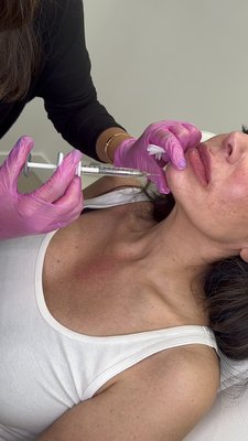 Dermal Fillers - Fillers restore volume, smooths line and wrinkles leaving you with smoother, more youthful-looking skin. It enhances facial features, defining and accentuating facial symmetry Dermal Fillers - Fillers restore volume, smooths line and wrinkles leaving you with smoother, more youthful-looking skin. It enhances facial features, defining and accentuating facial symmetry