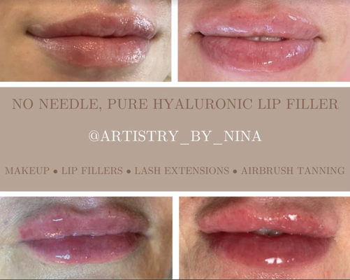 Hyaluronic Lip Filler - Call us today for all of your beauty needs. Hyaluronic Lip Filler - Call us today for all of your beauty needs.