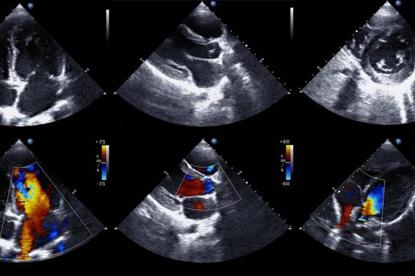 Echocardiogram - Home Based Screening - Echocardiogram is one of the best ways to check on the current state of your heart.  An Echo is a cardiac ultrasound exam that provides information about heart health. It shows and records heart function in motion and accurately measures size, dimensions, velocities, pumping function, and valvular disease severity.  The echo can identify various heart diseases.