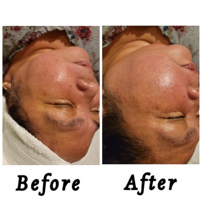 Before & After - These Before & After photos show you how the skin glows immediately after each facial. After a few series, you can drastically see an improvement in your skin.