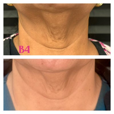 Offering free treatment valued at $350 off when you purchase a series (3 treatment) - This is Before and After Offering free treatment valued at $350 off when you purchase a series (3 treatment) - This is Before and After
