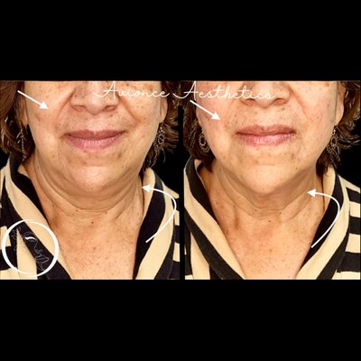 PDO Threads - This in-office procedure is performed using a surgical-grade self-dissolvable thread composed of Polydioxanone (PDO). By creating tension to the surrounding tissue, PDO threads tighten and lift instantly. The material self-dissolves and promotes collagen production during the process, inducing long term rejuvenation. This technique can also be used to treat facial acne scars. Downtime is minimal. 

Book your consultation today.