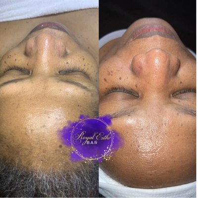 Facials - Skin has always and will forever be a passion of mine. I love to see my clients smiling faces after their session with me!
- Brittney, L.E. Owner of Royal Esthi Bar. Facials - Skin has always and will forever be a passion of mine. I love to see my clients smiling faces after their session with me!
- Brittney, L.E. Owner of Royal Esthi Bar.