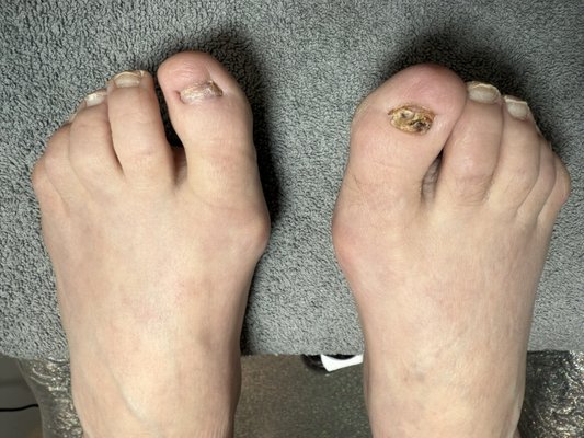 Toenail Restoration - This toenail restoration took about an hour. Client was very happy Toenail Restoration - This toenail restoration took about an hour. Client was very happy