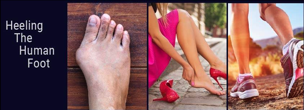 Innovative Bunion Surgery - The big toe is made up of two joints. A bunion forms when the enlarged joint becomes inflamed due to misalignment of the bones surrounding the joints. The ‘bump’ associated with bunions forms on the joint at the base of your big toe as your bones move out of place.
Successful bunion surgery can realign bone, balance ligaments and tendons and increase the level of functionality of the big toe joint thereby improving the overall health of the foot. Bunion surgery is usually performed as an outpatient procedure in either an ambulatory care center or a hospital outpatient facility. Bunions can also be performed in an office setting in a designated procedure room.
In some cases, patients can find relief without surgery. Although this will not remove the bunion, it can help keep it from worsening as well as reduce pain and inflammation. However, sometimes these types of treatments are not enough to alleviate your symptoms and surgery may be required. Innovative Bunion Surgery - The big toe is made up of two joints. A bunion forms when the enlarged joint becomes inflamed due to misalignment of the bones surrounding the joints. The ‘bump’ associated with bunions forms on the joint at the base of your big toe as your bones move out of place.
Successful bunion surgery can realign bone, balance ligaments and tendons and increase the level of functionality of the big toe joint thereby improving the overall health of the foot. Bunion surgery is usually performed as an outpatient procedure in either an ambulatory care center or a hospital outpatient facility. Bunions can also be performed in an office setting in a designated procedure room.
In some cases, patients can find relief without surgery. Although this will not remove the bunion, it can help keep it from worsening as well as reduce pain and inflammation. However, sometimes these types of treatments are not enough to alleviate your symptoms and surgery may be required.