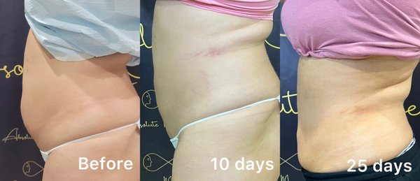 BodyTite Before & After - BodyTite is a minimally invasive body contouring procedure with liposuction. BodyTite combines Radio Frequency with Liposuction to tighten the skin and loosen the fat pockets that get removed with the liposuction.