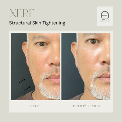 XERF Structural Skin Tightening - XERF™ Structural Skin Tightening at ANYO' Aesthetics
Lift. Tighten. Restore. Naturally.

Experience the next generation of non-surgical facial rejuvenation with XERF™ Structural Skin Tightening at ANYO' Aesthetics in El Cajon, California. We are proud to be the first and only XERF™ provider serving El Cajon and East County San Diego, including La Mesa, Santee, Lemon Grove, Spring Valley, La Presa, Lakeside, Rancho San Diego, Alpine, Jamul, Ramona, Julian, and Borrego Springs.

XERF™ is an advanced structural skin tightening treatment designed to lift, tighten, and rejuvenate aging skin by stimulating your body's natural collagen and elastin production. Unlike treatments that focus on only one layer of the skin, XERF™ uses dual-frequency monopolar radiofrequency technology to target multiple tissue depths for comprehensive skin remodeling.

How XERF™ Works

XERF™ combines 6.78 MHz radiofrequency to treat the superficial and mid-dermal layers with 2 MHz radiofrequency to reach deeper structural tissues, including the SMAS layer. This multi-depth approach promotes collagen remodeling, improves skin elasticity, enhances facial contours, and creates a naturally lifted appearance.

Its advanced Wave Fit™ pulse technology and integrated cryogen cooling system help maximize comfort while delivering consistent energy throughout the treatment—without needles, surgery, or significant downtime.

Benefits of XERF™ Structural Skin Tightening
Non-surgical facelift alternative
Lifts and tightens loose skin on the face and neck
Improves jawline definition and reduces the appearance of jowls
Enhances skin firmness and elasticity
Stimulates natural collagen and elastin production
Softens fine lines and wrinkles
Improves overall skin texture and tone
Comfortable treatment with integrated cooling technology
No needles, no anesthesia, and minimal downtime
Suitable for most skin types
Areas Commonly Treated
Full Face
Neck
Jawline
Cheeks
Under Chin
Forehead
Décolleté
Who Is a Good Candidate?

XERF™ is ideal for individuals experiencing mild to moderate skin laxity who want noticeable lifting and tightening without surgery. It is an excellent option for patients who want to maintain a youthful appearance while avoiding the downtime associated with facelift procedures.

What to Expect

Most patients benefit from a series of two treatments performed 4–6 weeks apart. While some patients notice an immediate tightening effect, collagen production continues to improve over the following weeks, with results becoming progressively more noticeable. Maintenance treatments may be recommended annually to help preserve results.

Why Choose ANYO' Aesthetics?

At ANYO' Aesthetics, every treatment is customized to your facial anatomy and aesthetic goals. Our philosophy is simple: Natural. Beautiful. Undetectable. We combine advanced technology with artistic facial assessment to deliver refreshed, youthful results that never look overdone.

Whether you're looking to improve skin laxity, redefine your jawline, or restore youthful firmness, XERF™ Structural Skin Tightening offers an innovative, non-surgical solution tailored to your needs.

Schedule your personalized consultation today and discover why patients throughout El Cajon, La Mesa, Santee, Spring Valley, Rancho San Diego, Lakeside, Alpine, Jamul, Ramona, Julian, and East County San Diego are choosing ANYO' Aesthetics for advanced skin tightening and facial rejuvenation.
