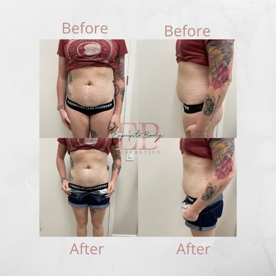 Ultrasound Cavitation - Client purchased Mega Fat Freeze Package Ultrasound Cavitation - Client purchased Mega Fat Freeze Package