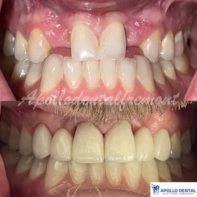 Dental Bridge - This are the examples of dental bridge done at Apollo Dental, Fremont, CA. This is to help the patient fill in the missing space. Dental implants was not an option so we did a dental bridge for the patient. Give you a call to see if you need a dental bridge. Dental Bridge - This are the examples of dental bridge done at Apollo Dental, Fremont, CA. This is to help the patient fill in the missing space. Dental implants was not an option so we did a dental bridge for the patient. Give you a call to see if you need a dental bridge.