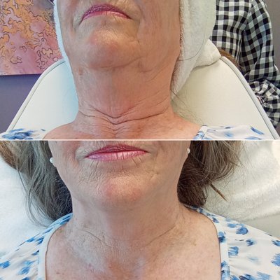 Cryo T Shock Facials - What Is Cryo T-Shock?

Cryo T-Shock is the most innovative and non-invasive modality to eliminate localized fat, reduce cellulite, as well as tone and tighten the skin. It offers a unique application of warm and cold to reshape and tighten the body and face. Cool T shock treatments destroy fat cells and increase skin collagen production during each session due to the thermal shock response.