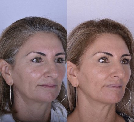PRP Cocktail - Introducing our advanced PRP Cocktail Treatment, blending Sculptra, SkinVive by Juvederm, and PRP injections for unparalleled skin rejuvenation. Harnessing the power of your body's natural healing factors, this cutting-edge therapy stimulates collagen production, promoting firmer, smoother skin texture. Experience diminished fine lines, improved elasticity, and a revitalized complexion. Elevate your skincare routine with our medically proven approach to radiant, youthful skin. PRP Cocktail - Introducing our advanced PRP Cocktail Treatment, blending Sculptra, SkinVive by Juvederm, and PRP injections for unparalleled skin rejuvenation. Harnessing the power of your body's natural healing factors, this cutting-edge therapy stimulates collagen production, promoting firmer, smoother skin texture. Experience diminished fine lines, improved elasticity, and a revitalized complexion. Elevate your skincare routine with our medically proven approach to radiant, youthful skin.