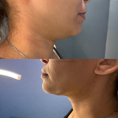 Body Contouring - Treatments can consists of the ALL or some of following:
Lipo Laser, Lipo Cavitation, RF Treatment, Wood Therapy, Vacuum Butt Lift Therapy Body Contouring - Treatments can consists of the ALL or some of following:
Lipo Laser, Lipo Cavitation, RF Treatment, Wood Therapy, Vacuum Butt Lift Therapy