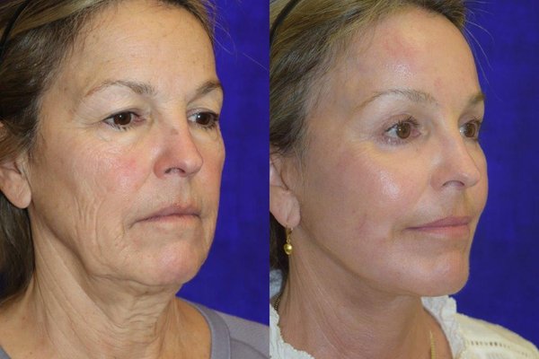 Facial Plastic Surgery - Before and After Facial Plastic Surgery performed by Victor Lacombe, M.D. Facial Plastic Surgery - Before and After Facial Plastic Surgery performed by Victor Lacombe, M.D.