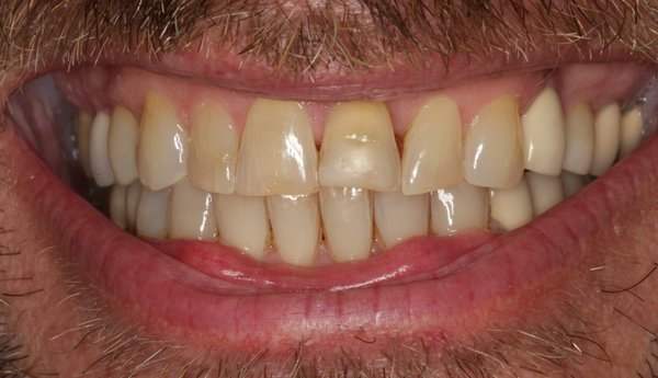 New Smile - This patient was unhappy with the shape and discoloration of his teeth. With Invisalign, teeth whitening, and natural-looking Emax crowns, we transformed his smile.