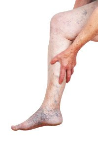Leg Ulcer Treatment - Leg ulcers are commonly caused by untreated vein reflux disease, poor arterial flow or diabetes. We specialize in the underlying cause for venous and arterial leg ulcers. Venous reflux disease can be treated non-invasively. Venous reflux and varicose veins can progress and cause skin changes such as darkening around the ankles, itching, bleeding and eventually ulceration of the skin. In many cases this can be treated and prevented. For arterial leg ulcers, blood flow needs to be restored to allow the wound to heal. A physician consultation along with ultrasound of the blood flow in the legs (arterial and venous) can help determine the cause of the ulcer and the treatment options.