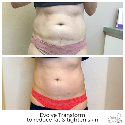 Body Contouring - This individual lightened up her abdomen with the  Evolve body contouring method which breaks down fat and tightens skin in a single step.