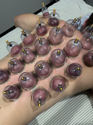Cupping therapy for Pain Relief - Whether you’re dealing with chronic pain, post-workout soreness, or just daily stress, our cupping therapy can help. This gentle yet effective treatment helps loosen tight muscles, boost circulation, and leave you feeling lighter and more relaxed. Great for anyone looking to take their massage experience to the next level. Cupping therapy for Pain Relief - Whether you’re dealing with chronic pain, post-workout soreness, or just daily stress, our cupping therapy can help. This gentle yet effective treatment helps loosen tight muscles, boost circulation, and leave you feeling lighter and more relaxed. Great for anyone looking to take their massage experience to the next level.