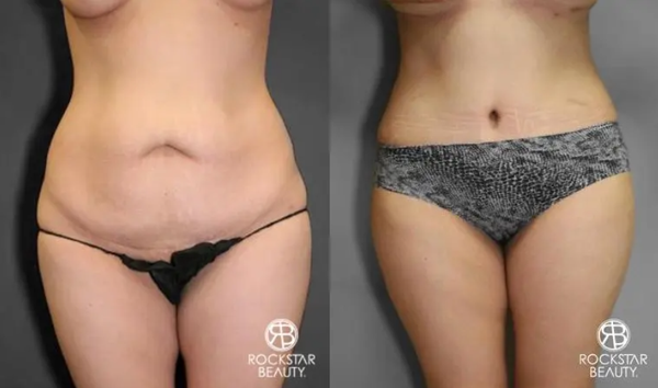 Tummy Tuck - A tummy tuck (abdominoplasty) is a surgical procedure that removes excess skin and fat from the abdomen while tightening the underlying muscles for a firmer, more contoured midsection. It’s not just for women—many men undergo tummy tucks, especially after significant weight loss.
This procedure can be combined with liposuction for enhanced body sculpting or included in a mommy makeover alongside breast surgery. Men often combine it with gynecomastia surgery for a more defined physique.
A tummy tuck is ideal for those struggling with loose skin and weakened muscles due to weight changes, aging, or pregnancy, offering long-lasting results with a more toned appearance. Tummy Tuck - A tummy tuck (abdominoplasty) is a surgical procedure that removes excess skin and fat from the abdomen while tightening the underlying muscles for a firmer, more contoured midsection. It’s not just for women—many men undergo tummy tucks, especially after significant weight loss.
This procedure can be combined with liposuction for enhanced body sculpting or included in a mommy makeover alongside breast surgery. Men often combine it with gynecomastia surgery for a more defined physique.
A tummy tuck is ideal for those struggling with loose skin and weakened muscles due to weight changes, aging, or pregnancy, offering long-lasting results with a more toned appearance.