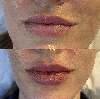 Lip Filler - When done correctly, lips can look very natural and beautiful. We do not believe in overfilling the lips or creating "duck lips". We rather focus on creating natural lips while supporting and balancing the surrounding anatomical structures. Lip Filler - When done correctly, lips can look very natural and beautiful. We do not believe in overfilling the lips or creating "duck lips". We rather focus on creating natural lips while supporting and balancing the surrounding anatomical structures.
