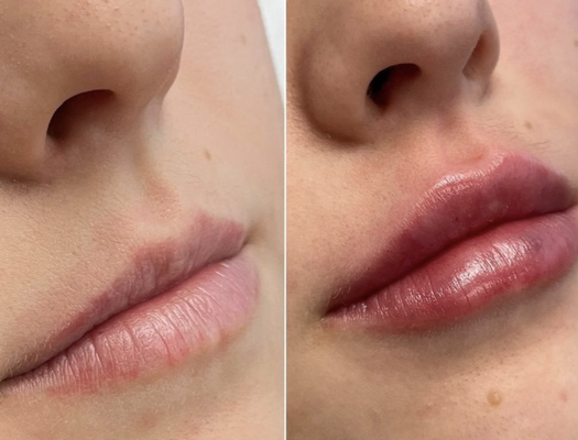 Lip Fillers - Perfect Pouts come in all beautiful shapes & sizes 👄 We’re here to make sure you find the natural enhancement you’re looking for that is just right for you and your unique, individual anatomy ✨ Lip Fillers - Perfect Pouts come in all beautiful shapes & sizes 👄 We’re here to make sure you find the natural enhancement you’re looking for that is just right for you and your unique, individual anatomy ✨