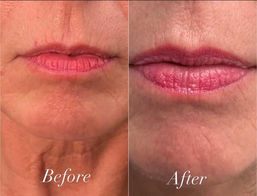 Medical Spa Treatments - At our med spa, we specialize in advanced medical aesthetic treatments designed to enhance, restore, and refine your natural beauty. One of our most sought-after services is our full syringe dermal filler treatment, expertly administered to smooth lines, restore volume, and contour facial features—specifically in the mid to lower face. Whether it’s softening nasolabial folds, enhancing cheeks, defining the jawline, or subtly plumping the lips, our fillers are tailored to your unique facial structure for natural-looking, refreshed results. With a focus on safety, precision, and artistry, we’re here to help you look and feel your absolute best—without surgery or downtime. Medical Spa Treatments - At our med spa, we specialize in advanced medical aesthetic treatments designed to enhance, restore, and refine your natural beauty. One of our most sought-after services is our full syringe dermal filler treatment, expertly administered to smooth lines, restore volume, and contour facial features—specifically in the mid to lower face. Whether it’s softening nasolabial folds, enhancing cheeks, defining the jawline, or subtly plumping the lips, our fillers are tailored to your unique facial structure for natural-looking, refreshed results. With a focus on safety, precision, and artistry, we’re here to help you look and feel your absolute best—without surgery or downtime.