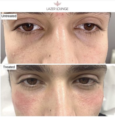 Under eye filler - One of the most popular treatments to help with under eye hollowness, darkness & to help you look refreshed. Visit website lazerlounge.com or IG/FB @lazerlounge to learn more Under eye filler - One of the most popular treatments to help with under eye hollowness, darkness & to help you look refreshed. Visit website lazerlounge.com or IG/FB @lazerlounge to learn more