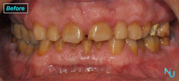Full Mouth Reconstruction - Before and After Images of a Full Mouth Reconstruction Performed at Nu Dentistry.