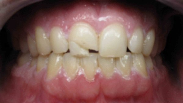 Single Anterior Crown - Front tooth suffered a trauma on a Saturday. Bonded the tooth at the emergency visit (pic 2) and finally restored with a single porcelain crown. Single Anterior Crown - Front tooth suffered a trauma on a Saturday. Bonded the tooth at the emergency visit (pic 2) and finally restored with a single porcelain crown.