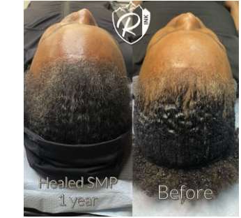 Healed Scalp Micropigmentation - Scalp micropigmentation or SMP is the process of adding permanent cosmetic pigmentation to the scalp. It’s a safe, non-surgical, non-invasive advanced hair restoration procedure. In laments terms, scalp micropigmentation can be thought of as a scalp tattoo that mimics actual hair follicles, giving the illusion of natural hair. At Rainer Ink, our professional staff prides themselves in SMP that looks so real that only the client knows it’s not! Healed Scalp Micropigmentation - Scalp micropigmentation or SMP is the process of adding permanent cosmetic pigmentation to the scalp. It’s a safe, non-surgical, non-invasive advanced hair restoration procedure. In laments terms, scalp micropigmentation can be thought of as a scalp tattoo that mimics actual hair follicles, giving the illusion of natural hair. At Rainer Ink, our professional staff prides themselves in SMP that looks so real that only the client knows it’s not!