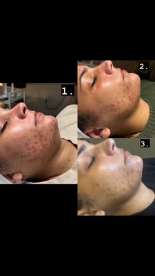 Acne Lift Chemical Peel and Lightening Lift Chemical Peel Results - Both chemical peels are done in a series of 5 treatments following the Signature Facelift Peel. The first chemical peel treatment is done 7 days after the Signature Facelift Peel. The following chemical peel treatments are then done 2 weeks apart. Best to start a Chemical peel treatment in the winter times when temperatures are lower. Acne Lift Chemical Peel and Lightening Lift Chemical Peel Results - Both chemical peels are done in a series of 5 treatments following the Signature Facelift Peel. The first chemical peel treatment is done 7 days after the Signature Facelift Peel. The following chemical peel treatments are then done 2 weeks apart. Best to start a Chemical peel treatment in the winter times when temperatures are lower.